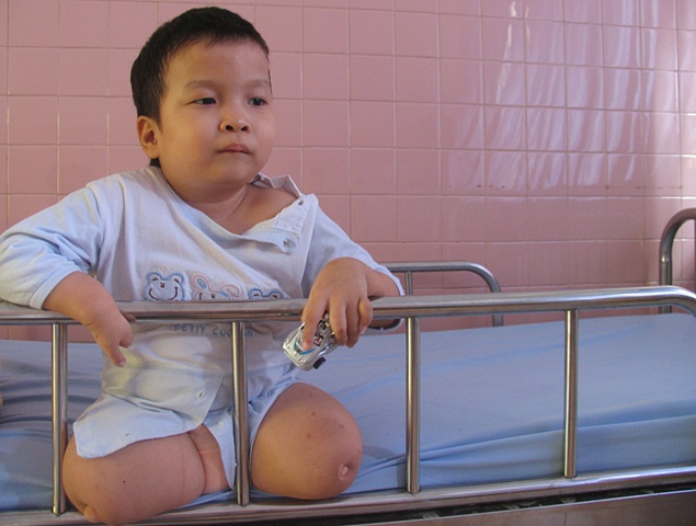 A child plays with a small car in Tu' Du' hospital.  He will live his life in a ward here, in downtown Ho Chi Minh City.