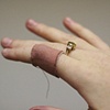 Wound