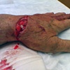 Hand Injury