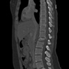 Broken Spine