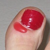A blood blister I got from walking for over an hour on a stinking treadmill in high heels... 
