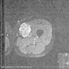 My multi-lobular tumor
