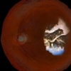 the eye