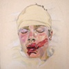 Trauma Series