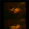 Haroutioun Simonian: Uterus