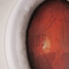 Vitreous Humor