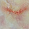 Self after thyroidectomy w/ hickey