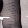 "scars"