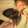 Fixing my ear