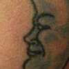 Left arm Before 