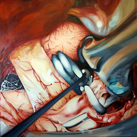 Howington's Aneurysm